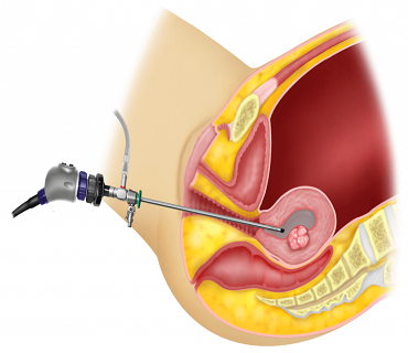 Hysteroscopy