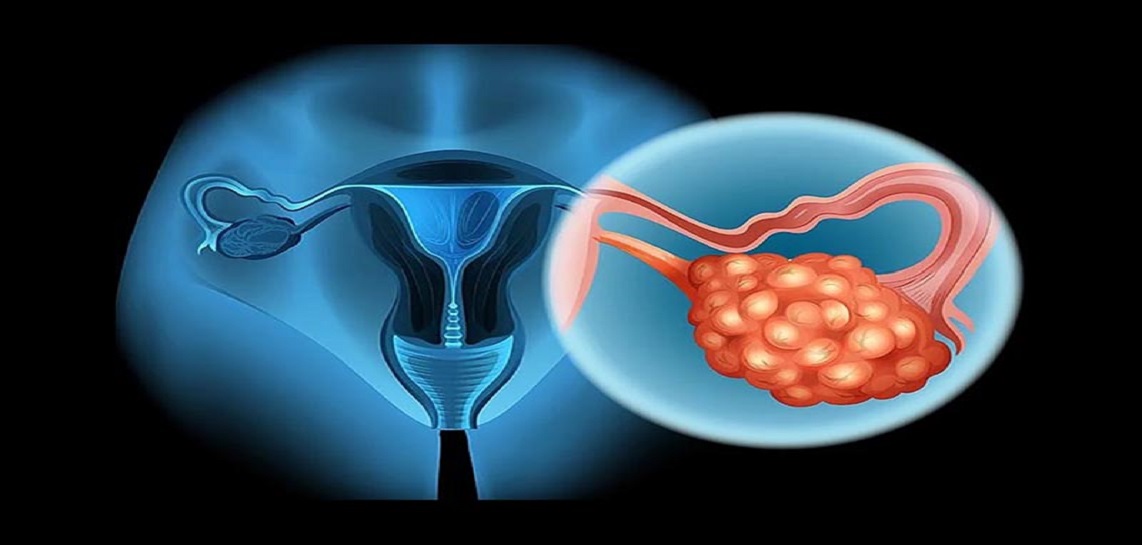 Ovarian Cysts