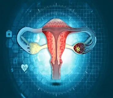 Fibroids