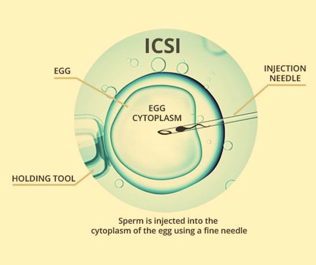 ICSI Treatment